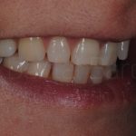 Microcarillas-sin-Tallado-Dental-1