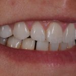 Microcarillas-sin-Tallado-Dental-10