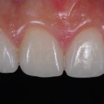 Microcarillas-sin-Tallado-Dental-11