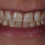 Microcarillas-sin-Tallado-Dental
