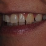 Microcarillas-sin-Tallado-Dental-2