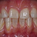 Microcarillas-sin-Tallado-Dental-3