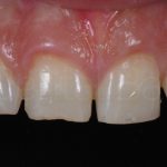 Microcarillas-sin-Tallado-Dental-4
