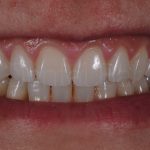 Microcarillas-sin-Tallado-Dental-6