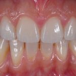 Microcarillas-sin-Tallado-Dental-8