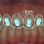 Microcarillas-sin-Tallado-Dental-81