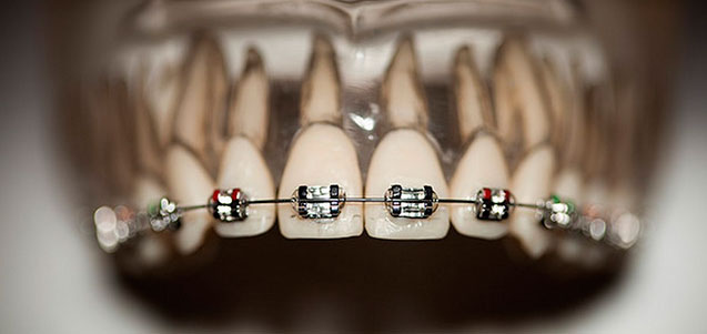 Diferencia entre los brackets de zafiro y los cerámicos