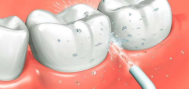 ¿Cómo se utiliza un irrigador bucal?