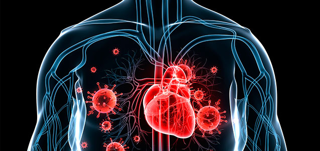 Endocarditis infecciosa