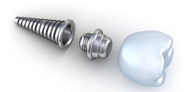 Implantes de carga inmediata