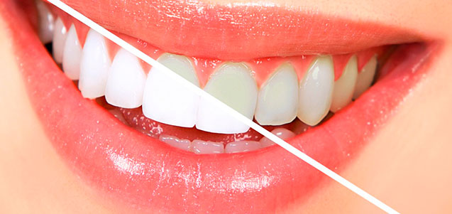 Blanqueamientos dentales