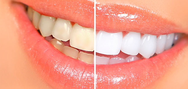 Blanqueamiento dental
