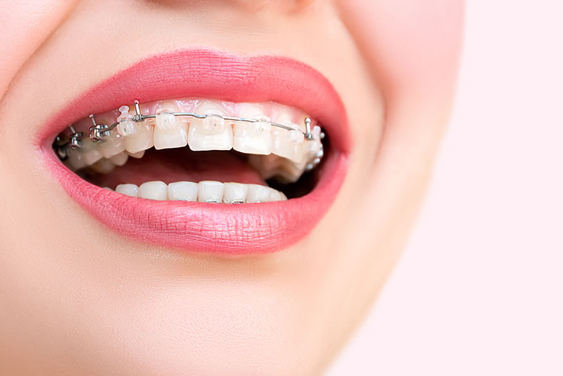 Brackets de zafiro en Barcelona