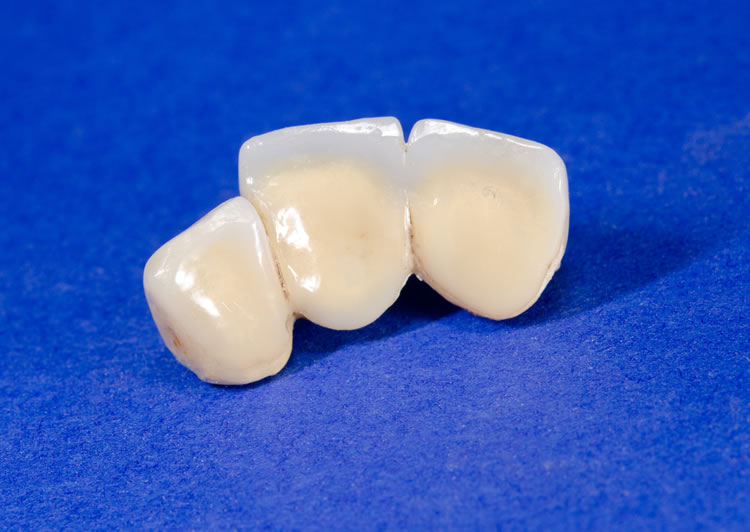 provisionales dentales Barcelona