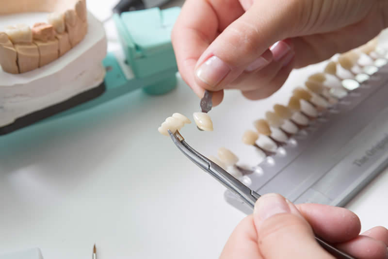 carillas dentales de disilacato de litio