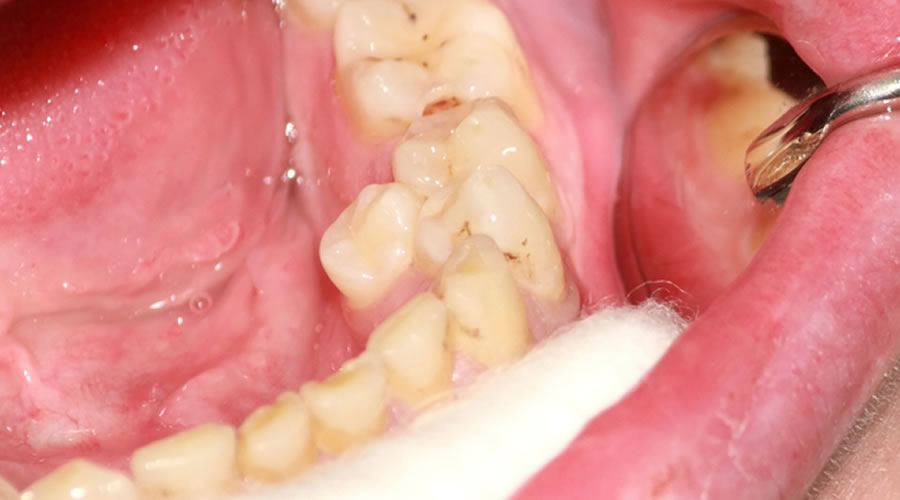 Hiperdoncia en un paciente