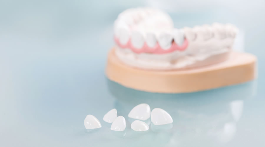 carillas de porcelana o composite