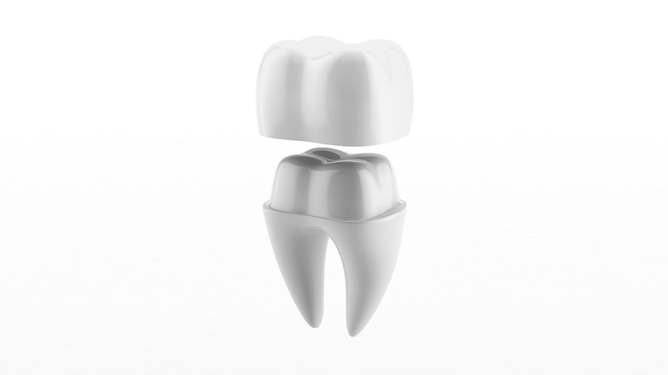 coronas fundas dentales Barcelona