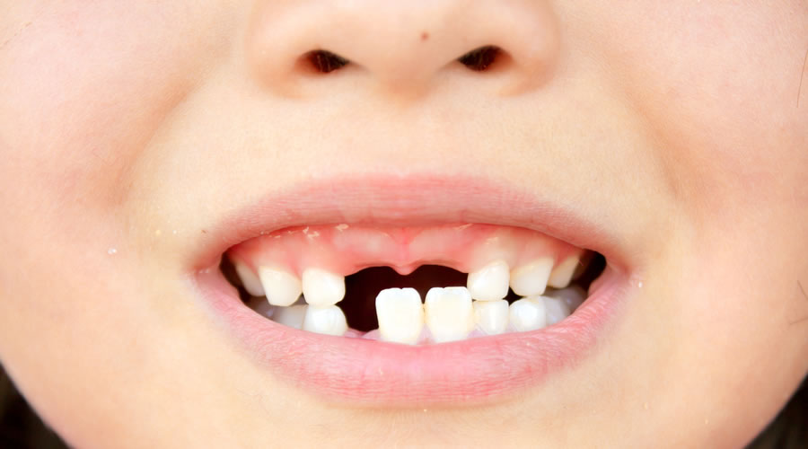 dientes rotos
