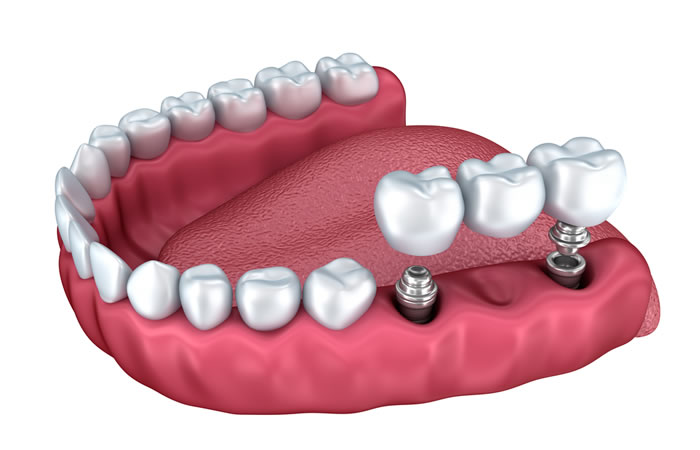 protesis sobre implantes dentales barcelona