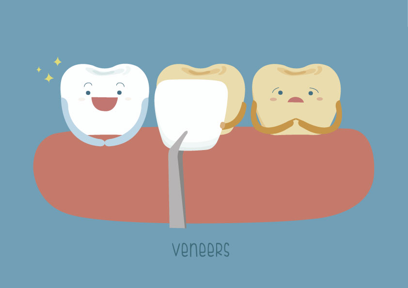Carillas dentales vs coronas dentales Barcelona