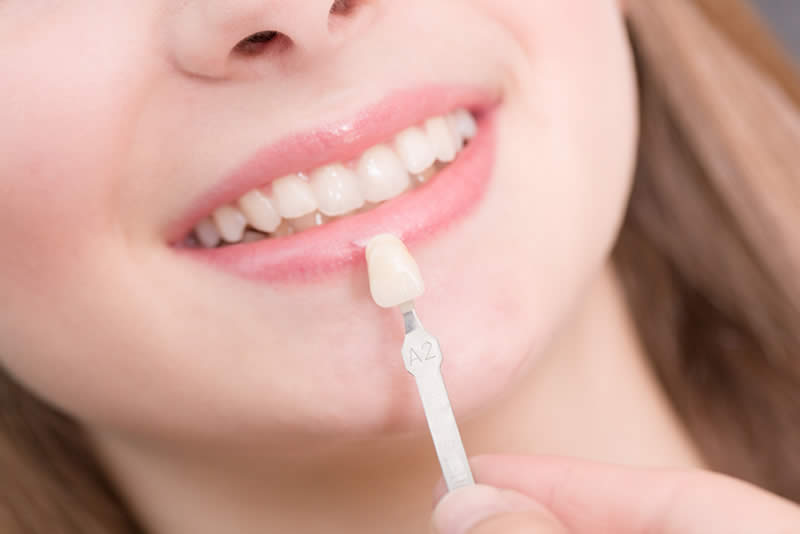 carillas de porcelana color dientes Barcelona