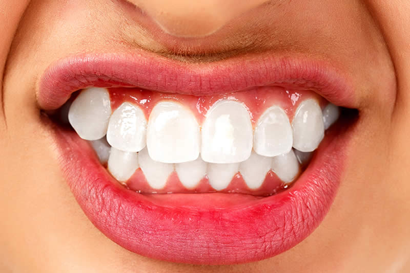 Estrés desgaste dental y Bruxismo