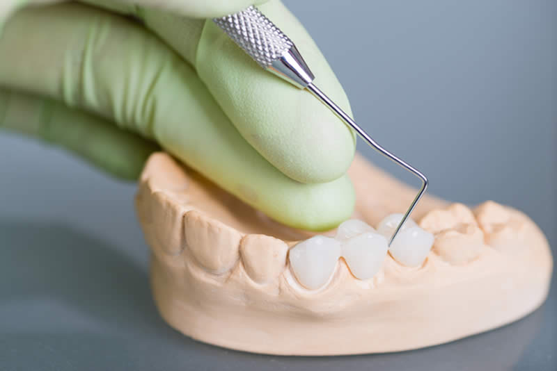 Incrustacion dental Barcelona