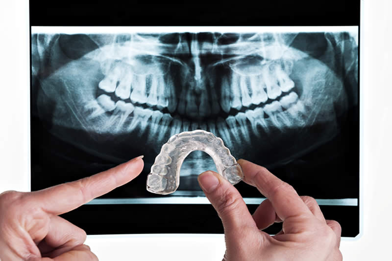Ferula Dental para el bruxismo