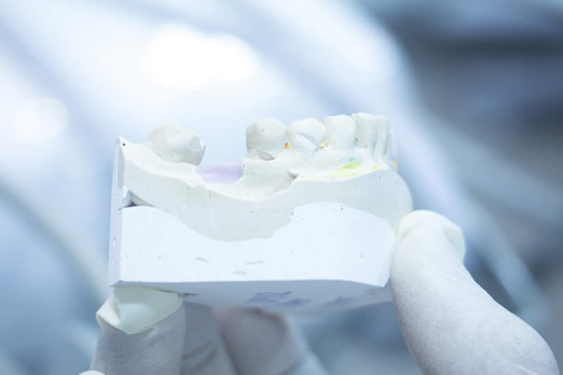 Encerado diagnostico estetica dental barcelona