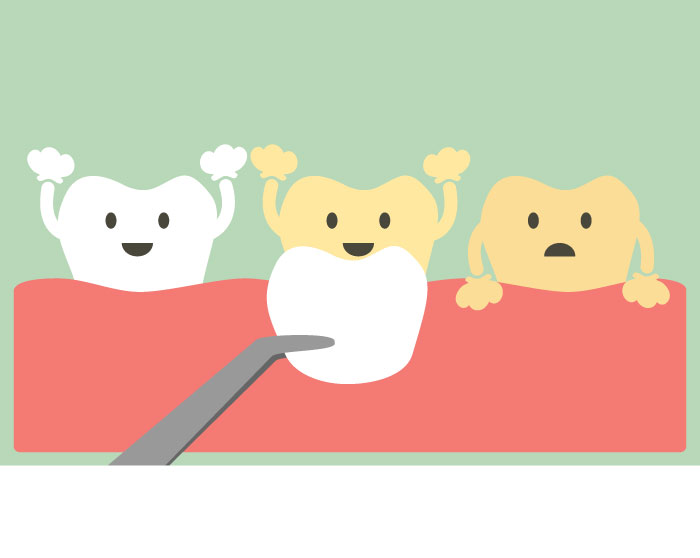 carillas de porcelana para mejorar el aspecto de sus dientes