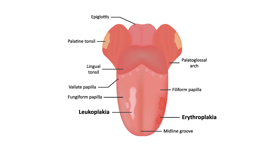 LA LEUCOPLASIA. UNA ENFERMEDAD BUCAL