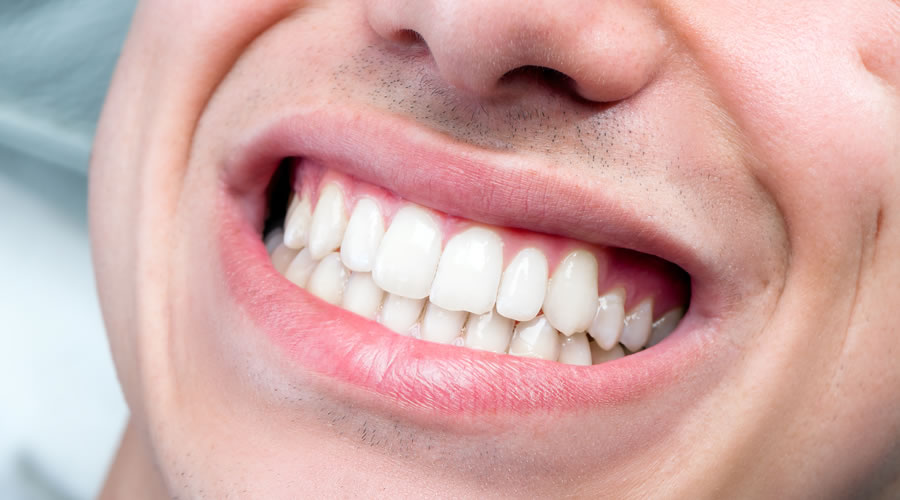 bruxismo dental