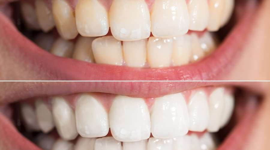 blanqueamiento dental