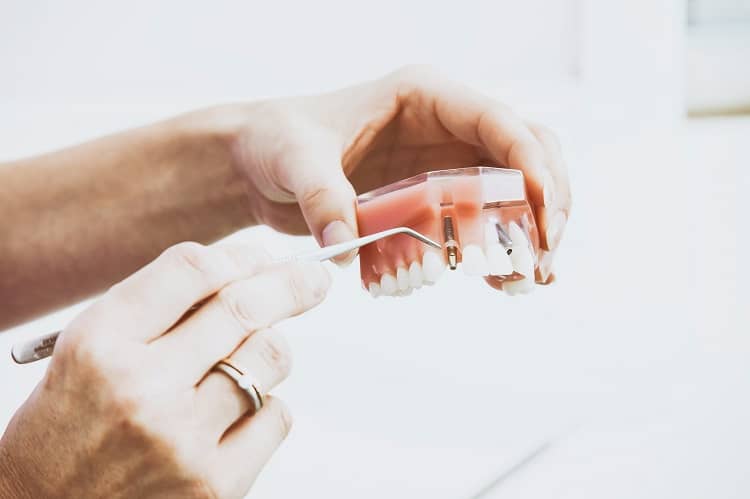 limpieza dental en barcelona